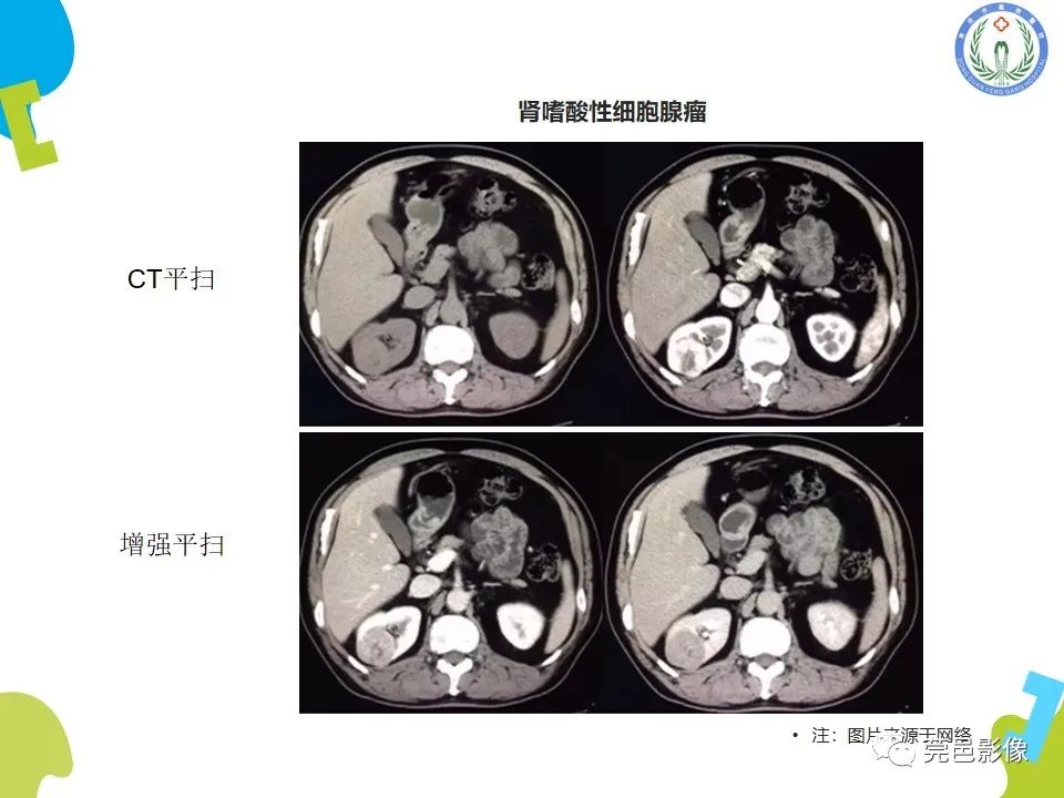 影像PPT - 【PPT】肾嫌色细胞癌影像表现及鉴别诊断-24