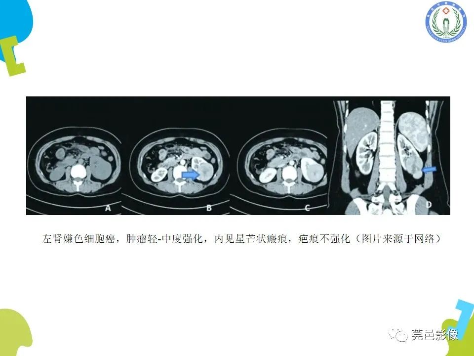 影像PPT - 【PPT】肾嫌色细胞癌影像表现及鉴别诊断-20