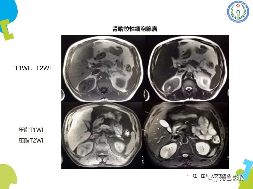 影像PPT - 【PPT】肾嫌色细胞癌影像表现及鉴别诊断-25