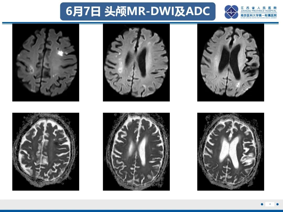 影像PPT - 【PPT】中枢神经系统红斑狼疮-5