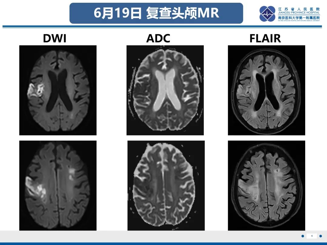 影像PPT - 【PPT】中枢神经系统红斑狼疮-7