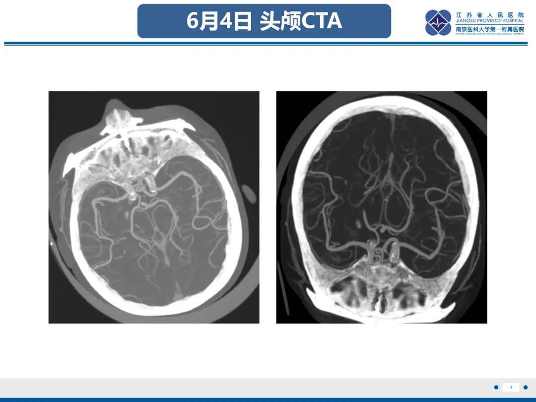 影像PPT - 【PPT】中枢神经系统红斑狼疮-3