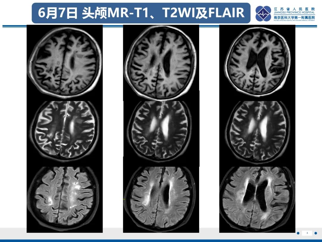 影像PPT - 【PPT】中枢神经系统红斑狼疮-4