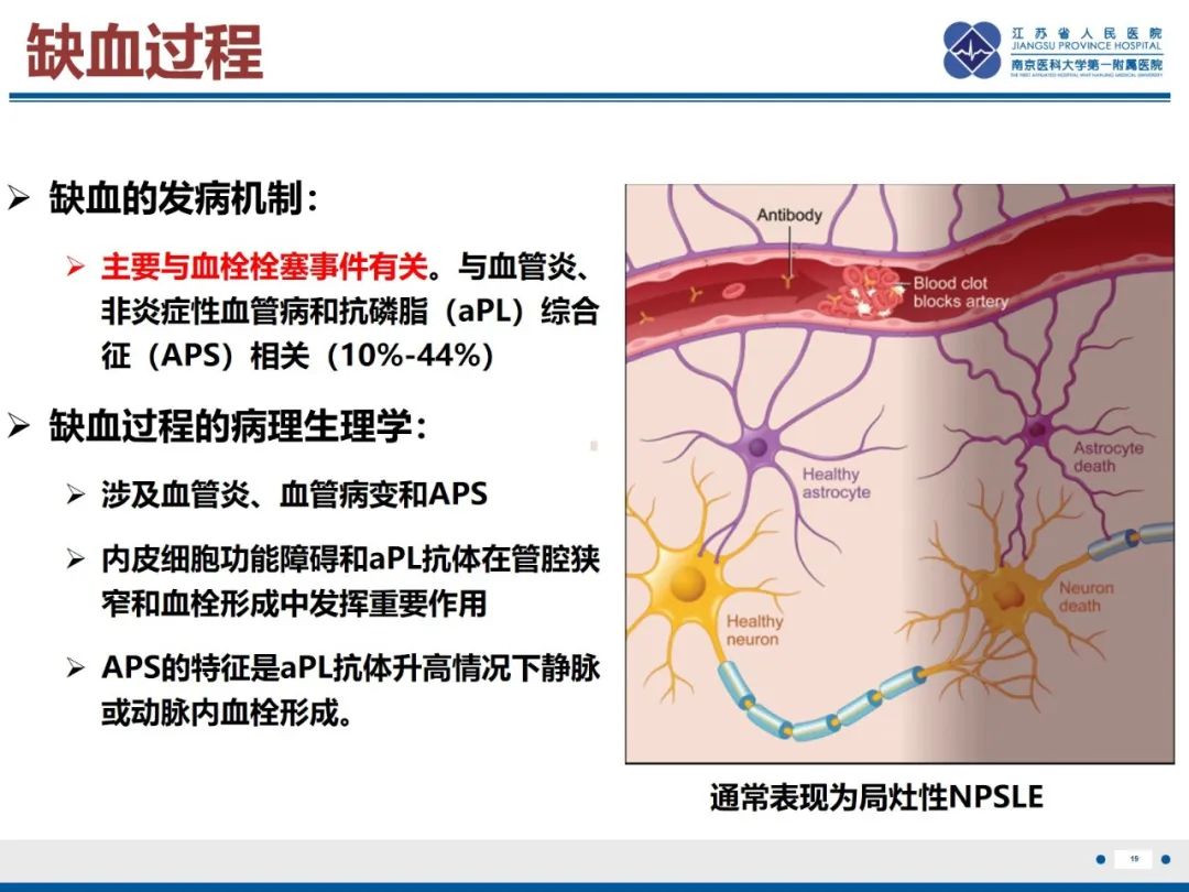 影像PPT - 【PPT】中枢神经系统红斑狼疮-20