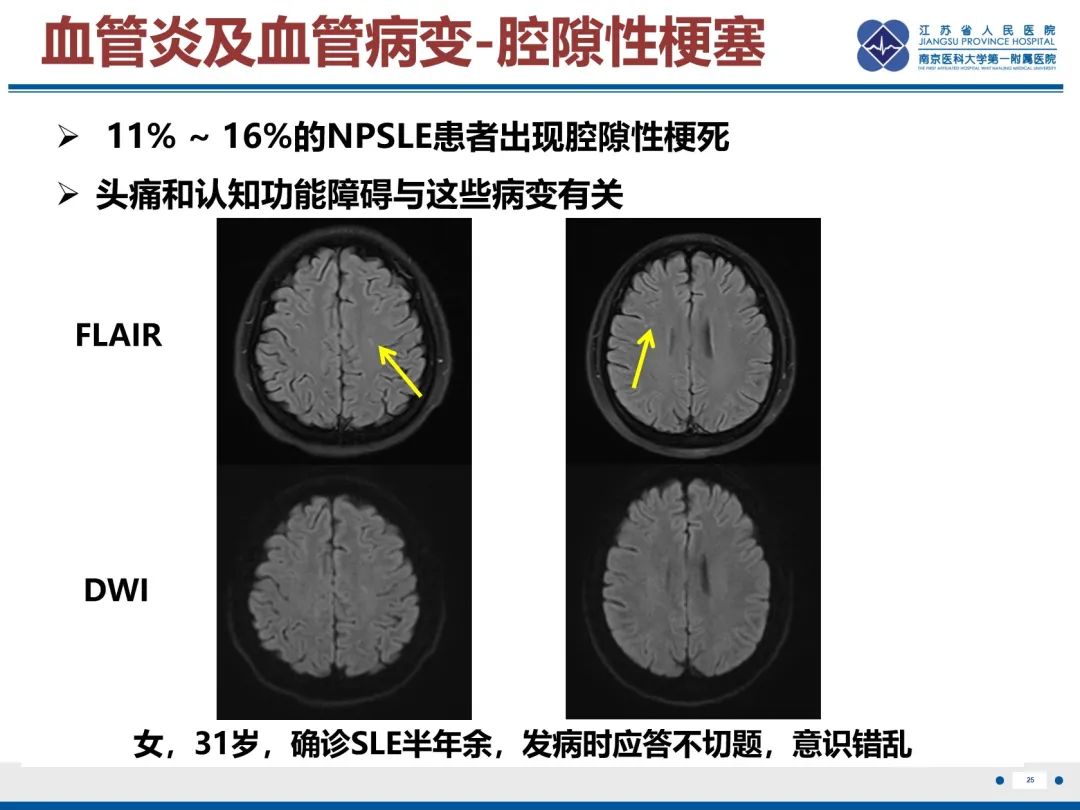 影像PPT - 【PPT】中枢神经系统红斑狼疮-26