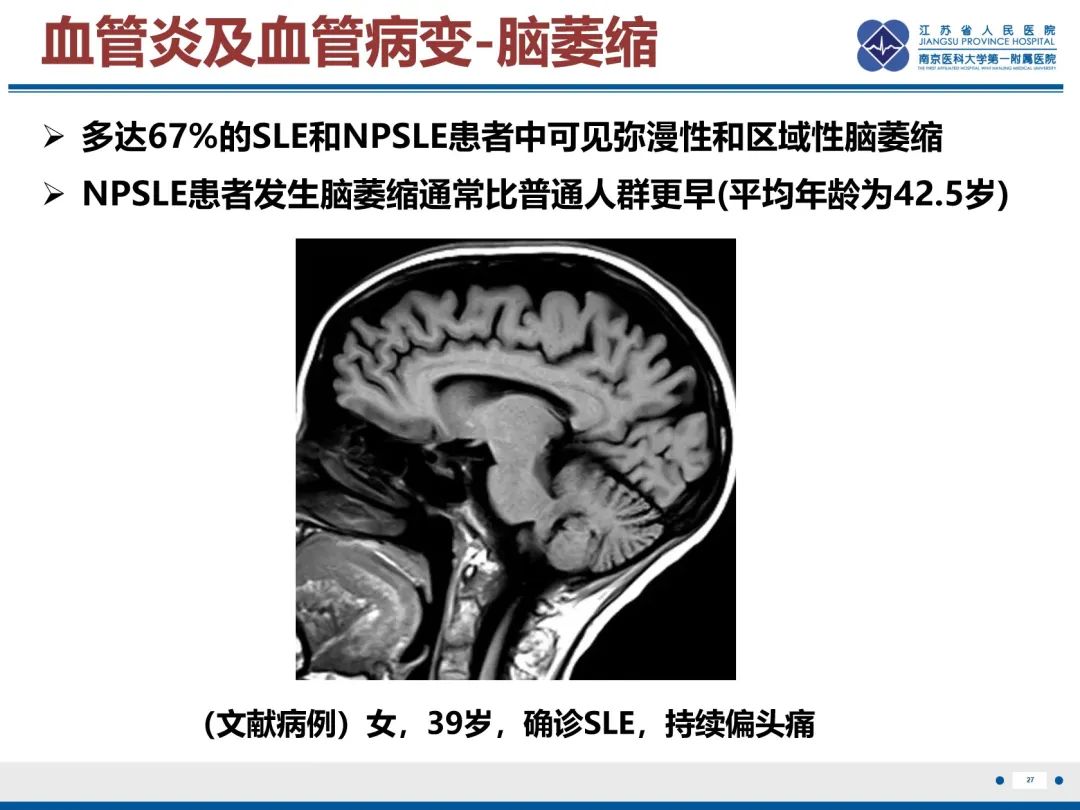 影像PPT - 【PPT】中枢神经系统红斑狼疮-28