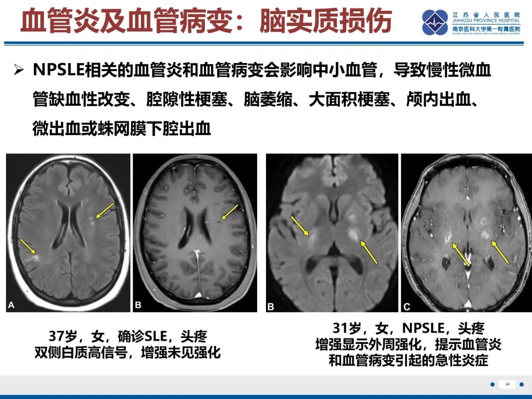 影像PPT - 【PPT】中枢神经系统红斑狼疮-25