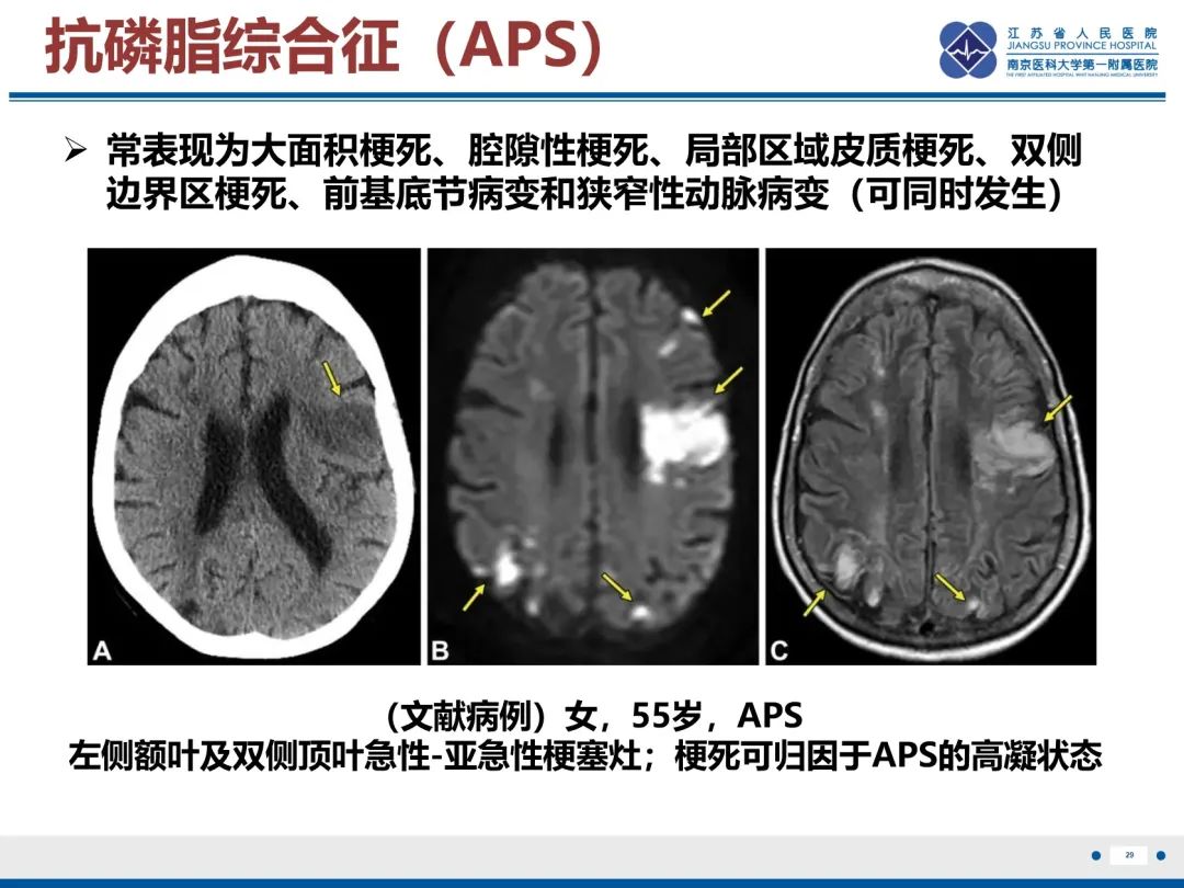 影像PPT - 【PPT】中枢神经系统红斑狼疮-30