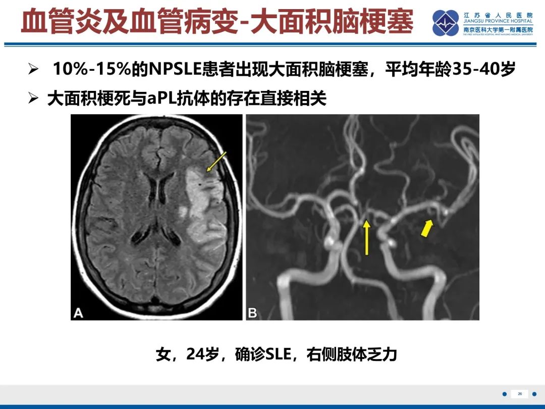 影像PPT - 【PPT】中枢神经系统红斑狼疮-27