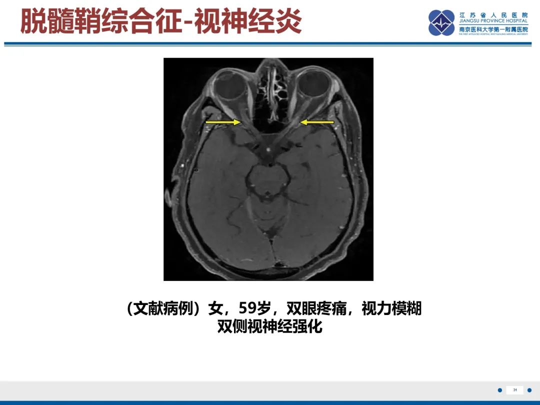 影像PPT - 【PPT】中枢神经系统红斑狼疮-32