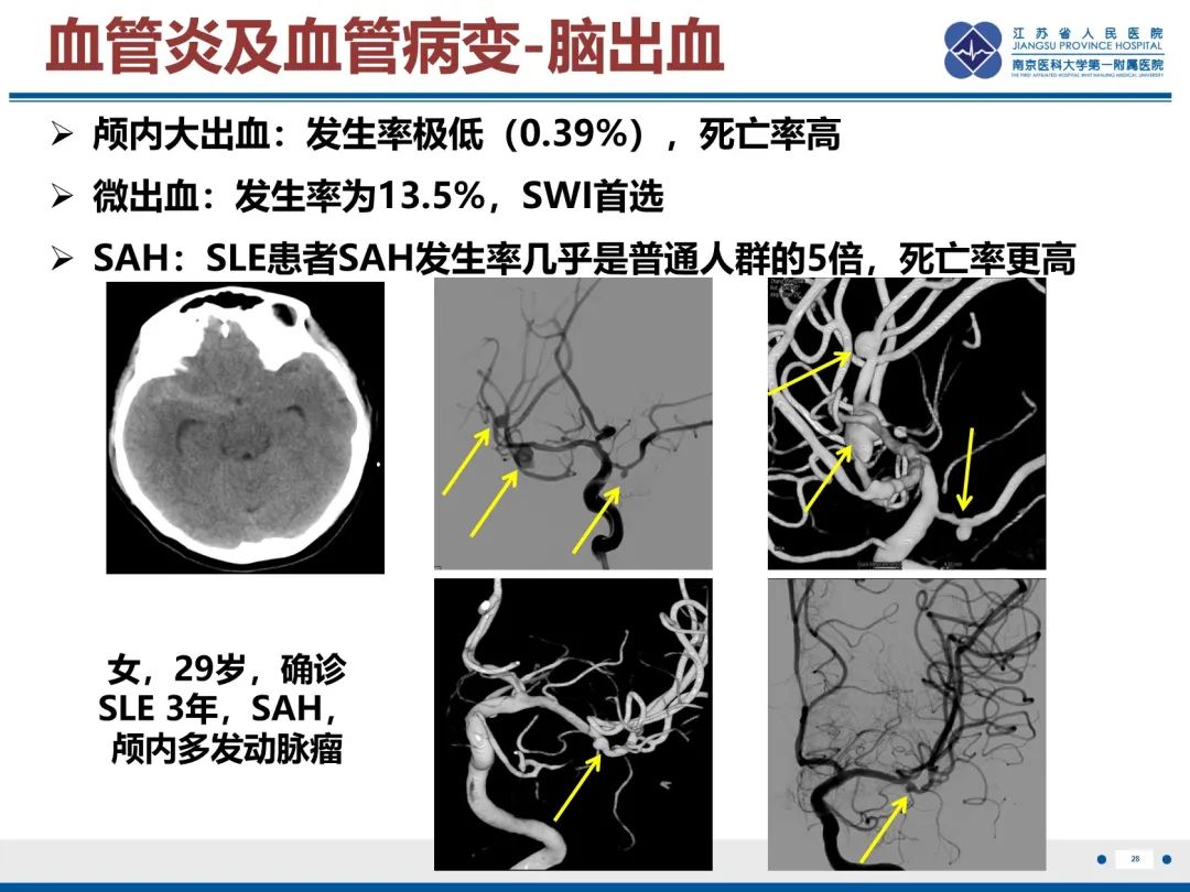 影像PPT - 【PPT】中枢神经系统红斑狼疮-29