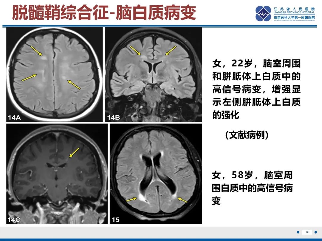 影像PPT - 【PPT】中枢神经系统红斑狼疮-33