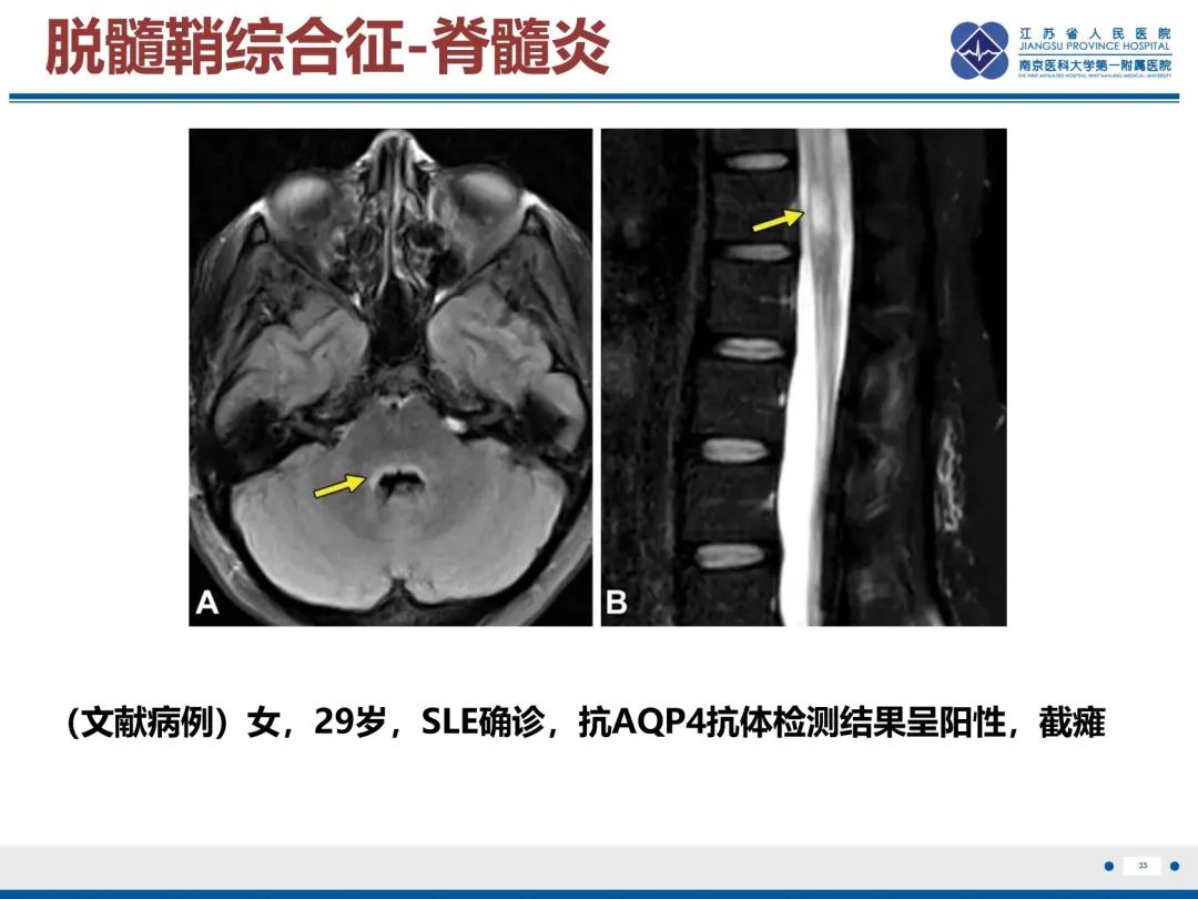 影像PPT - 【PPT】中枢神经系统红斑狼疮-34