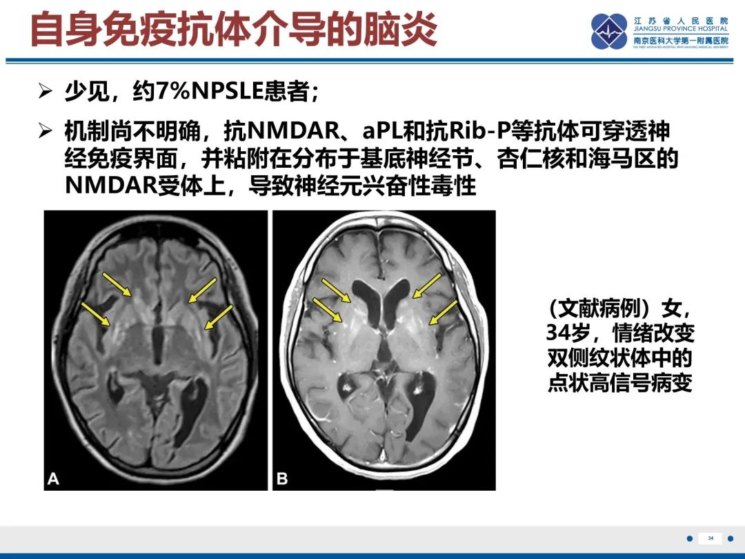 影像PPT - 【PPT】中枢神经系统红斑狼疮-35