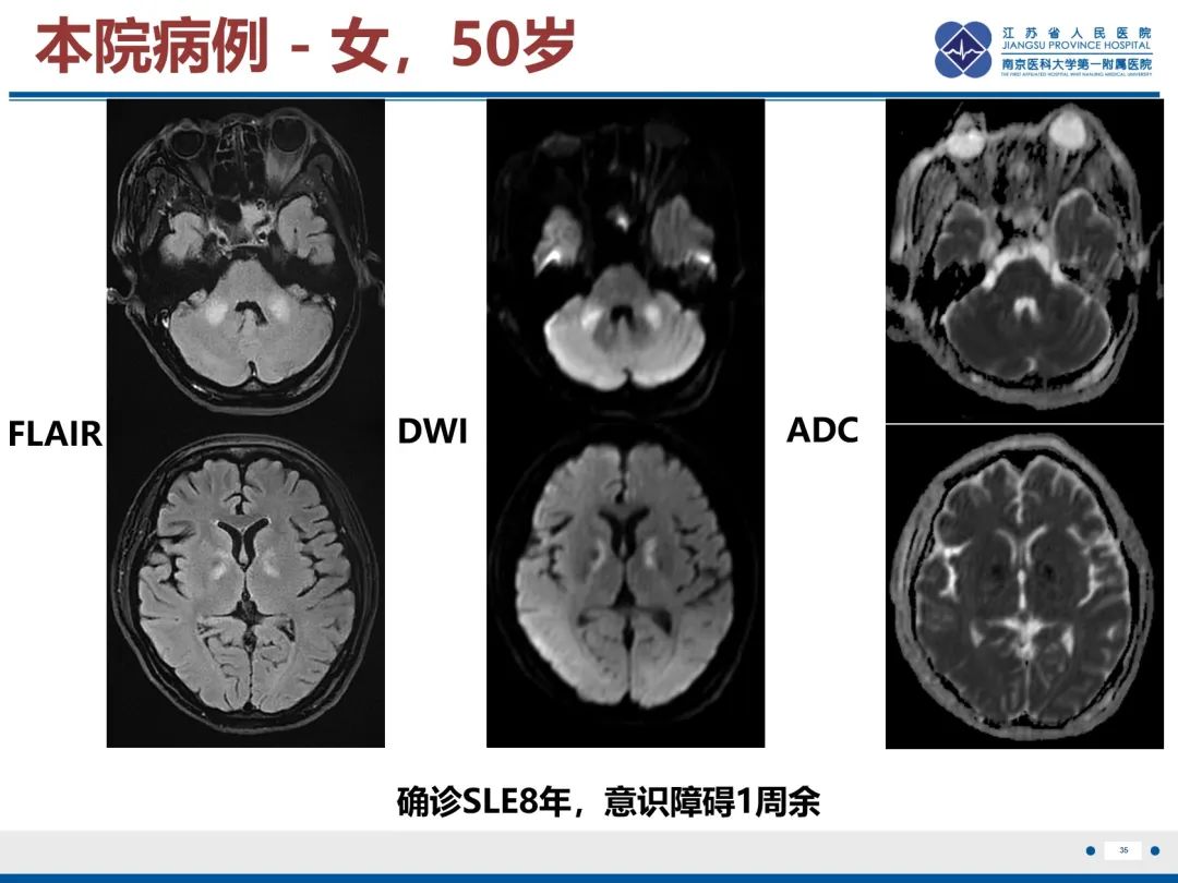 影像PPT - 【PPT】中枢神经系统红斑狼疮-36