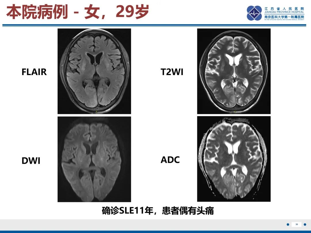 影像PPT - 【PPT】中枢神经系统红斑狼疮-37