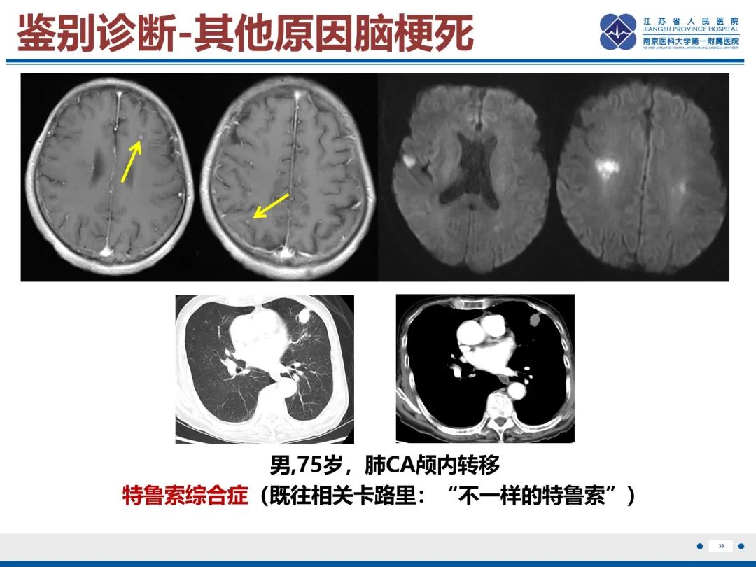 影像PPT - 【PPT】中枢神经系统红斑狼疮-40