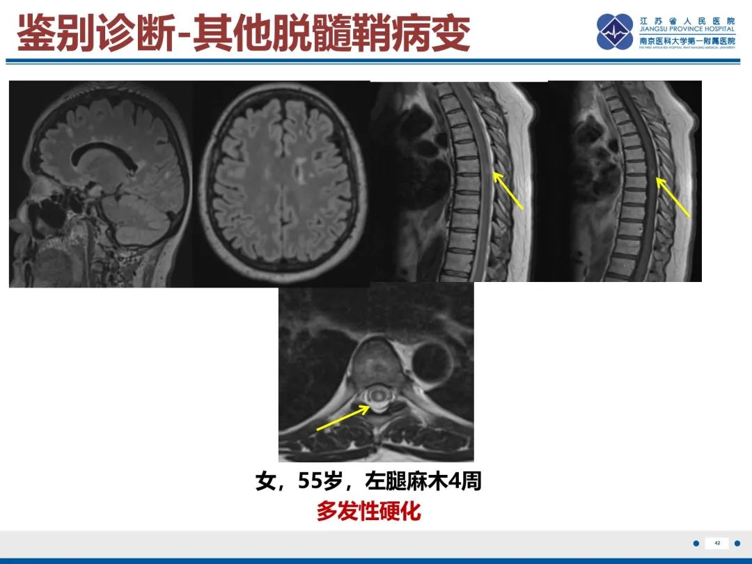 影像PPT - 【PPT】中枢神经系统红斑狼疮-43