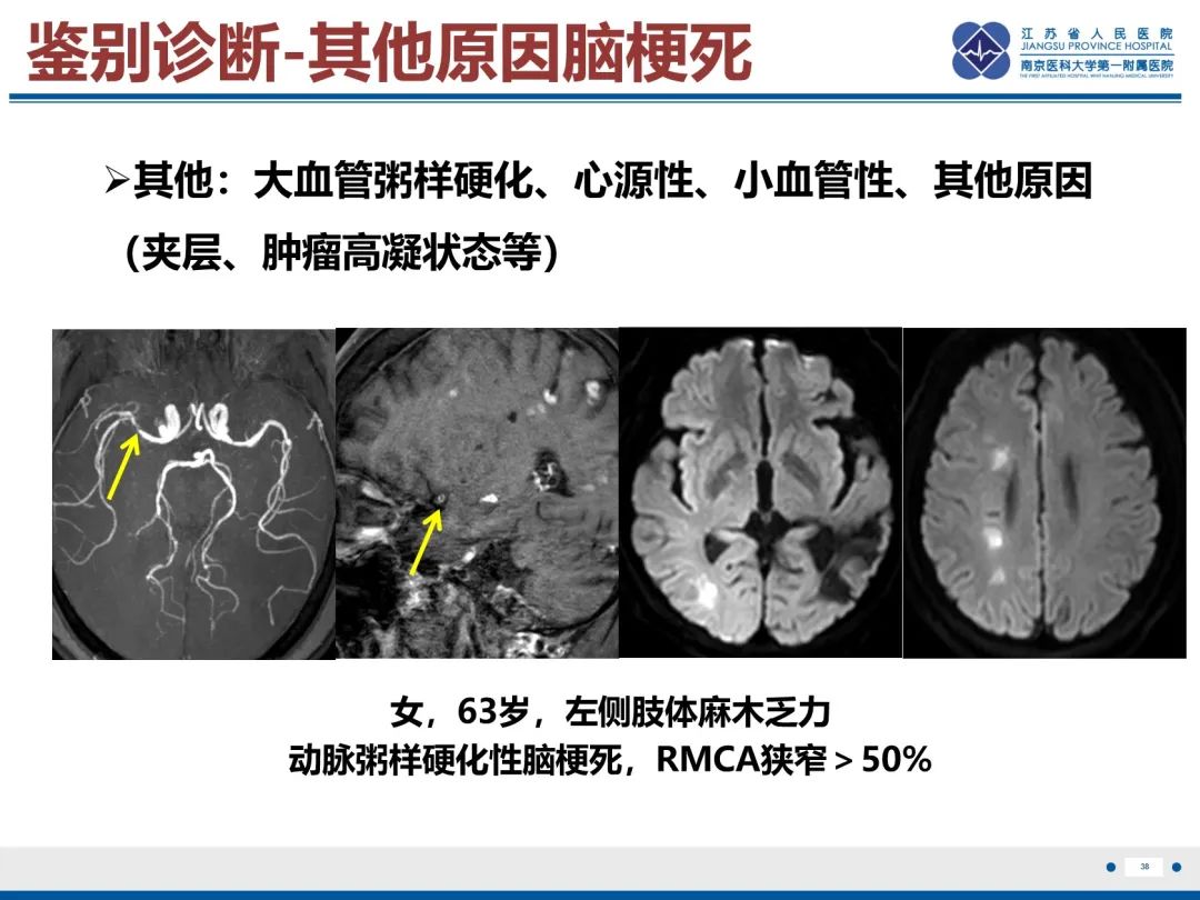 影像PPT - 【PPT】中枢神经系统红斑狼疮-39
