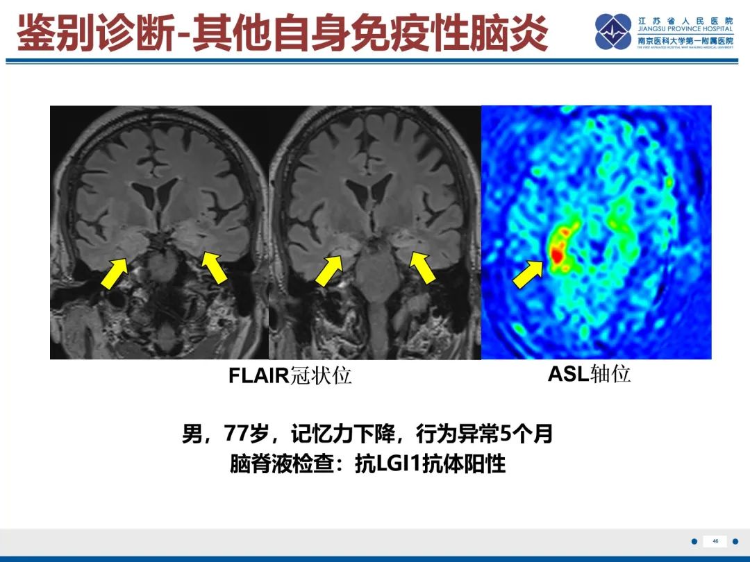 影像PPT - 【PPT】中枢神经系统红斑狼疮-47