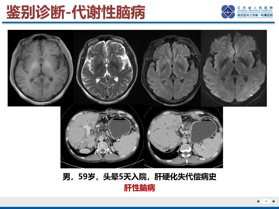 影像PPT - 【PPT】中枢神经系统红斑狼疮-45