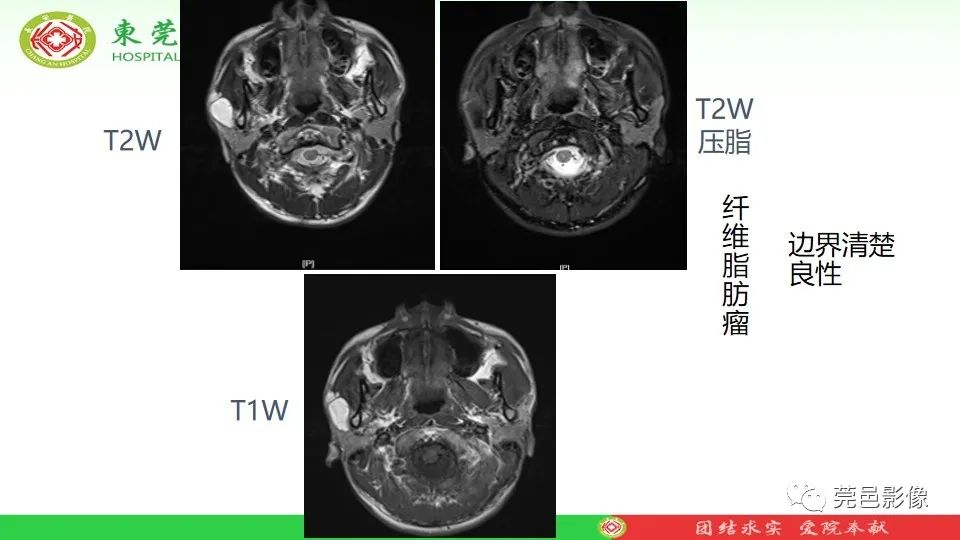 影像PPT - 【PPT】MRI征象在腮腺占位良恶性鉴别中的应用-12