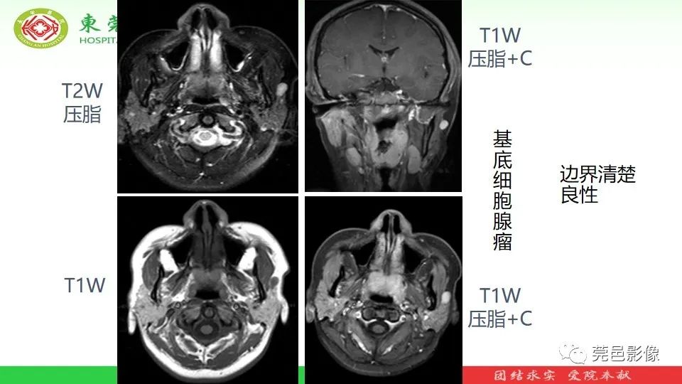 影像PPT - 【PPT】MRI征象在腮腺占位良恶性鉴别中的应用-13