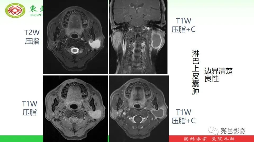影像PPT - 【PPT】MRI征象在腮腺占位良恶性鉴别中的应用-15