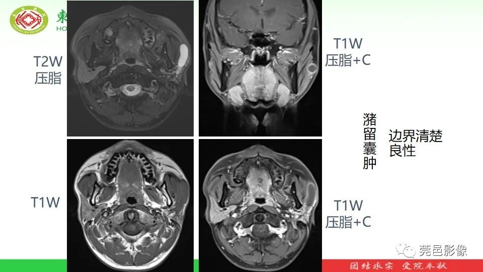 影像PPT - 【PPT】MRI征象在腮腺占位良恶性鉴别中的应用-16