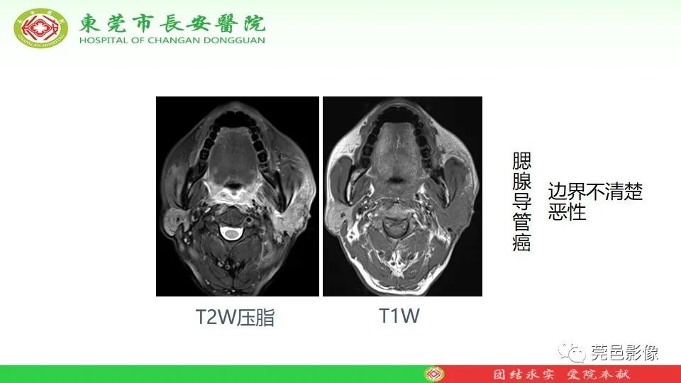 影像PPT - 【PPT】MRI征象在腮腺占位良恶性鉴别中的应用-17