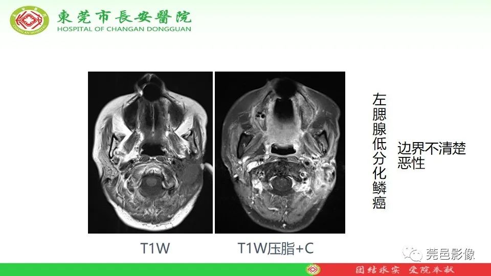影像PPT - 【PPT】MRI征象在腮腺占位良恶性鉴别中的应用-18