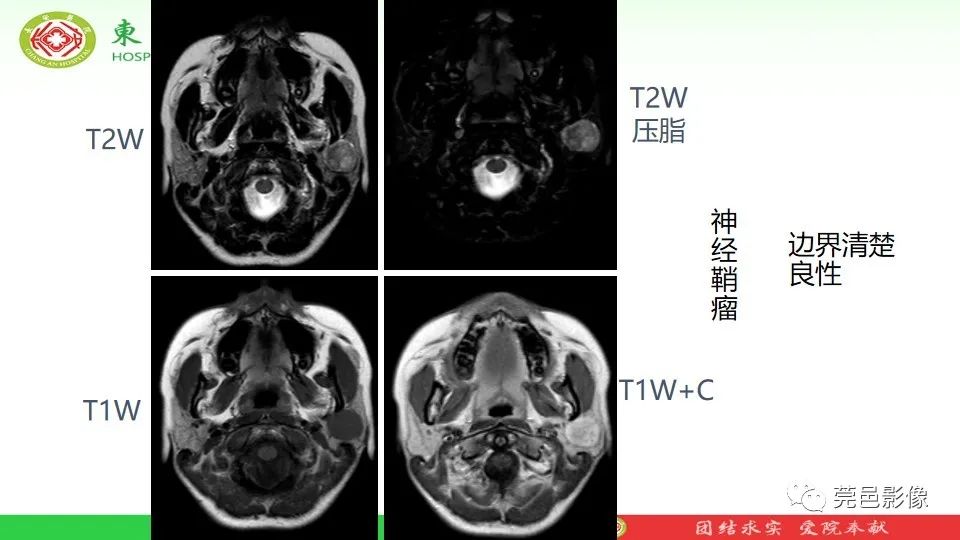 影像PPT - 【PPT】MRI征象在腮腺占位良恶性鉴别中的应用-14
