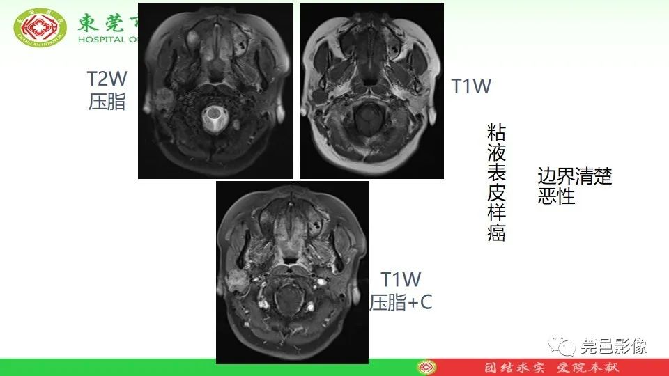 影像PPT - 【PPT】MRI征象在腮腺占位良恶性鉴别中的应用-19