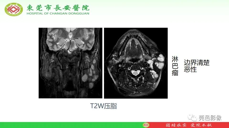 影像PPT - 【PPT】MRI征象在腮腺占位良恶性鉴别中的应用-21