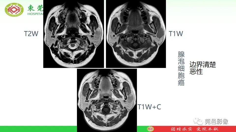 影像PPT - 【PPT】MRI征象在腮腺占位良恶性鉴别中的应用-20