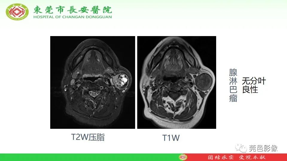 影像PPT - 【PPT】MRI征象在腮腺占位良恶性鉴别中的应用-25