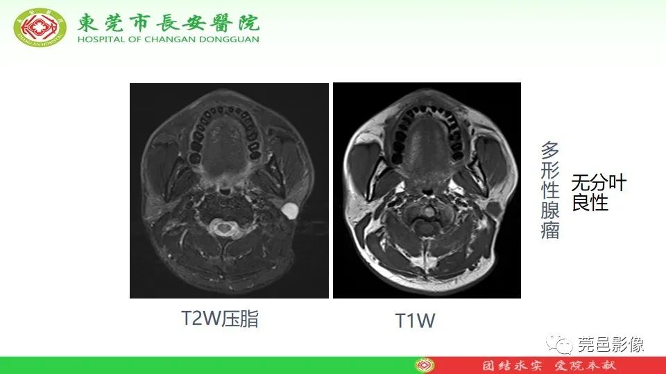 影像PPT - 【PPT】MRI征象在腮腺占位良恶性鉴别中的应用-26