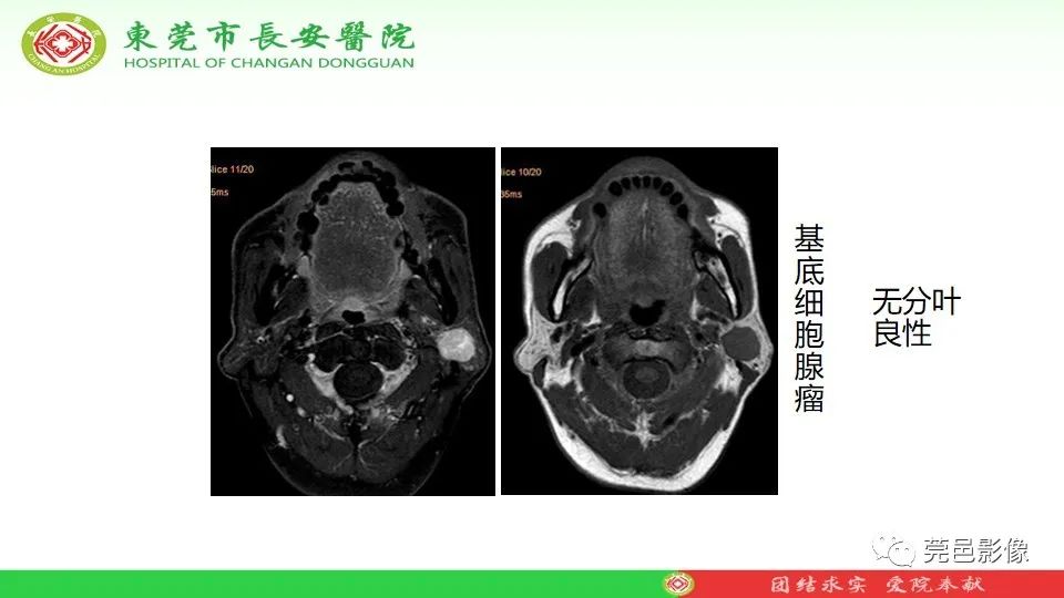 影像PPT - 【PPT】MRI征象在腮腺占位良恶性鉴别中的应用-27