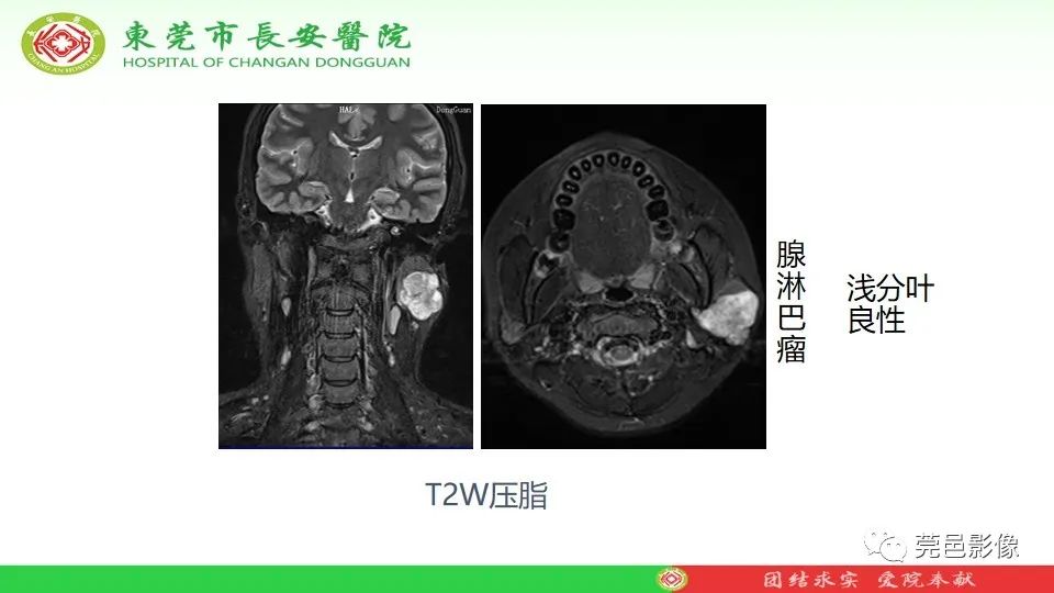 影像PPT - 【PPT】MRI征象在腮腺占位良恶性鉴别中的应用-29