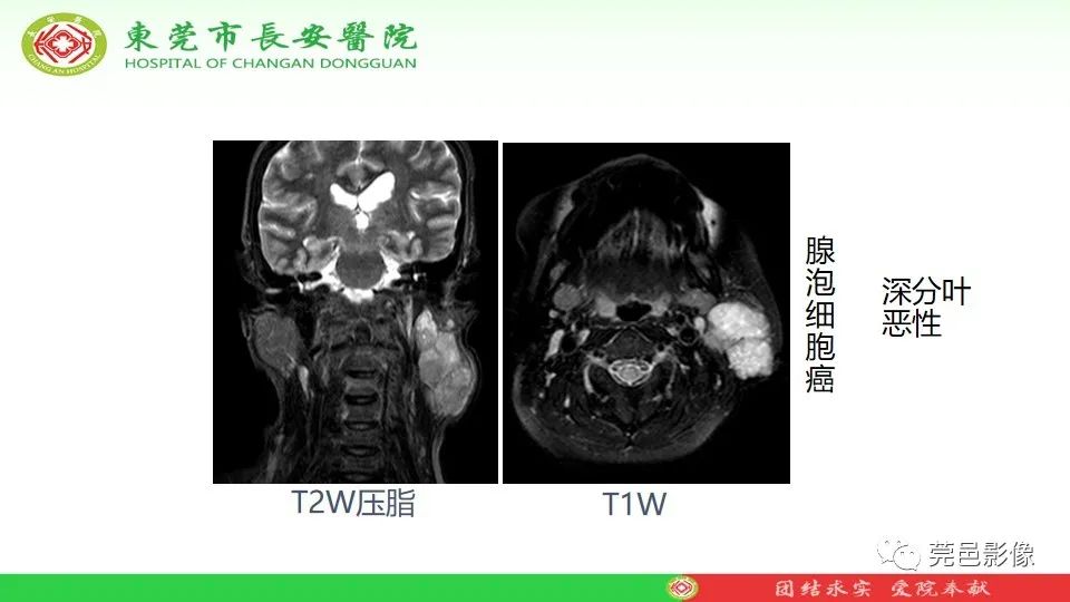 影像PPT - 【PPT】MRI征象在腮腺占位良恶性鉴别中的应用-30