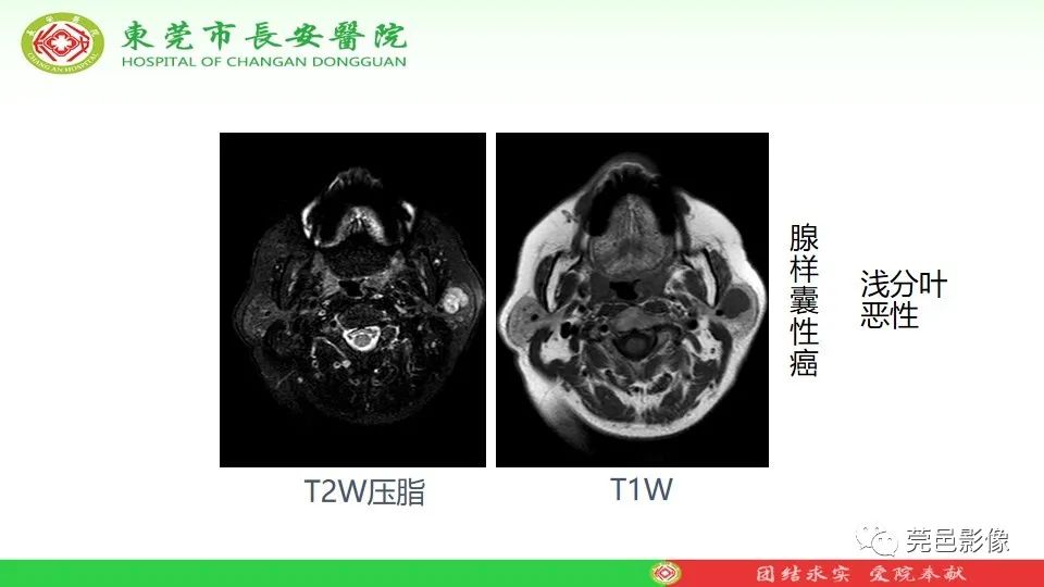 影像PPT - 【PPT】MRI征象在腮腺占位良恶性鉴别中的应用-31