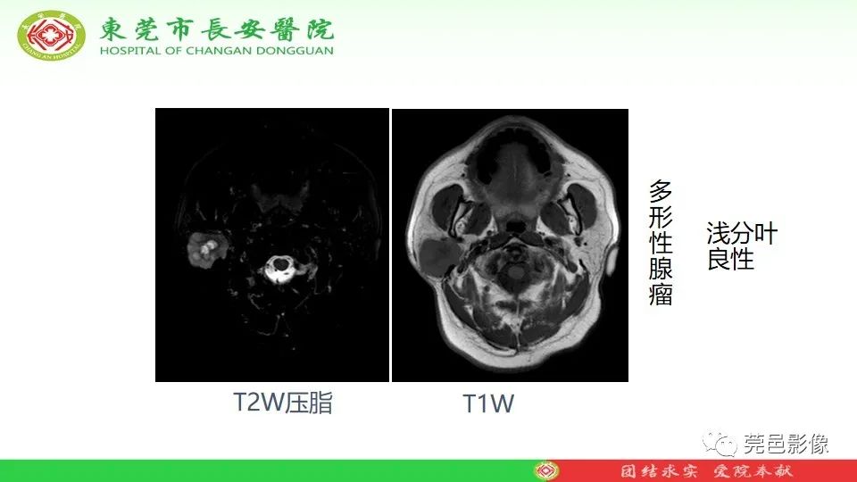 影像PPT - 【PPT】MRI征象在腮腺占位良恶性鉴别中的应用-28