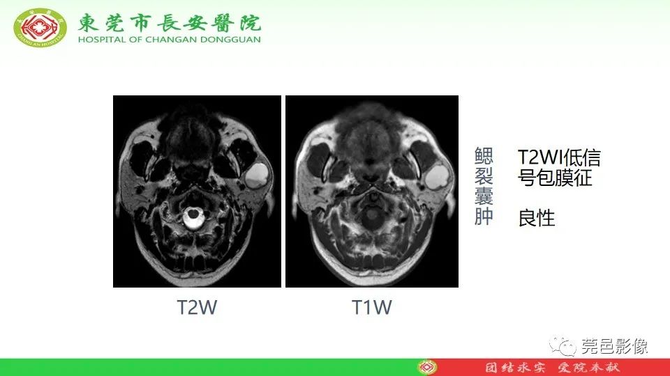 影像PPT - 【PPT】MRI征象在腮腺占位良恶性鉴别中的应用-38