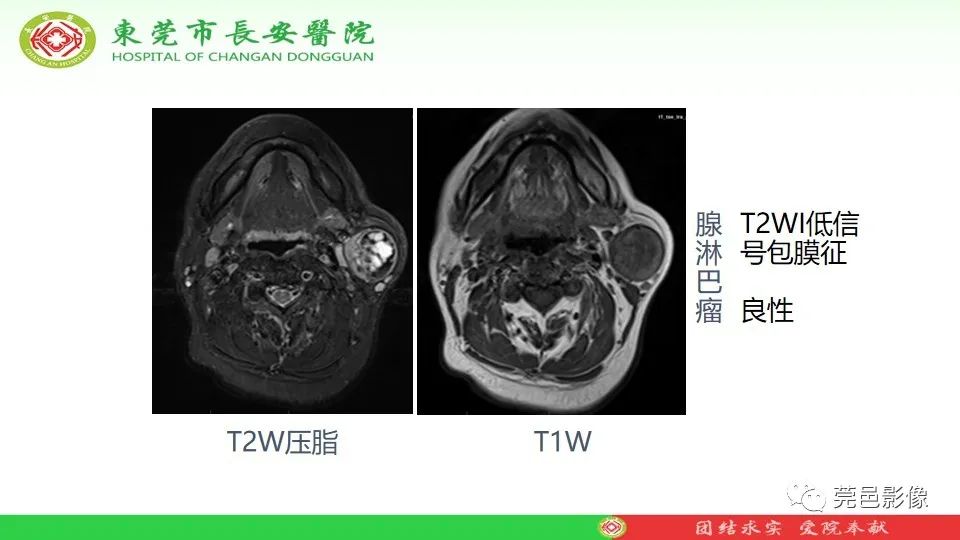 影像PPT - 【PPT】MRI征象在腮腺占位良恶性鉴别中的应用-39