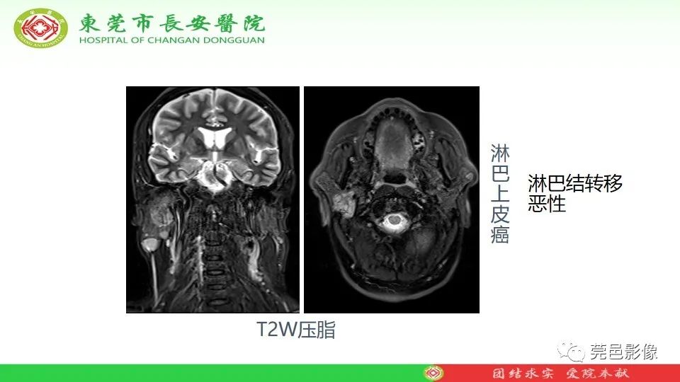 影像PPT - 【PPT】MRI征象在腮腺占位良恶性鉴别中的应用-34