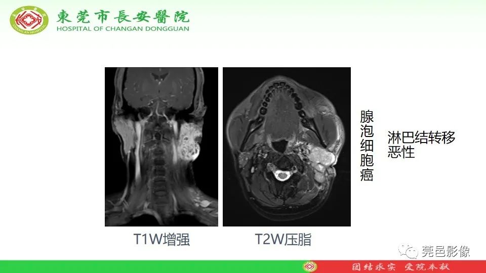 影像PPT - 【PPT】MRI征象在腮腺占位良恶性鉴别中的应用-35