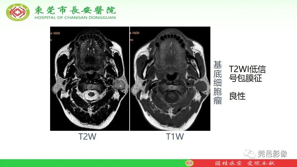 影像PPT - 【PPT】MRI征象在腮腺占位良恶性鉴别中的应用-40