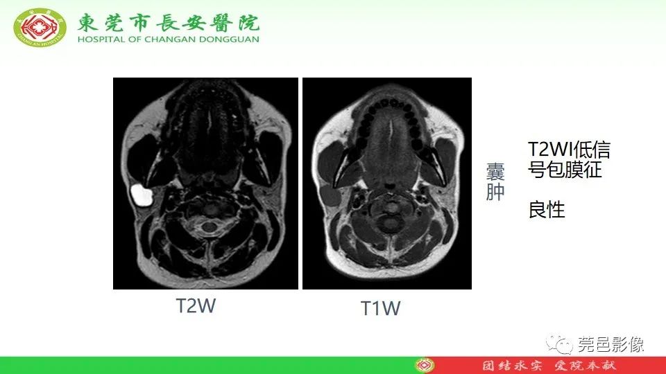 影像PPT - 【PPT】MRI征象在腮腺占位良恶性鉴别中的应用-37
