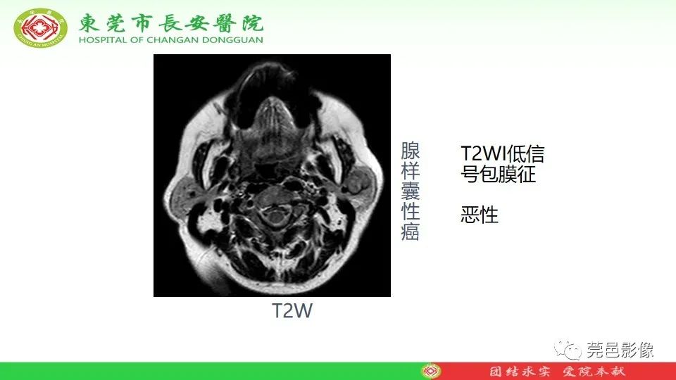 影像PPT - 【PPT】MRI征象在腮腺占位良恶性鉴别中的应用-43