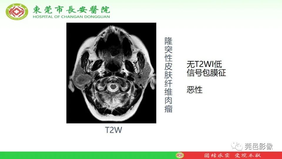 影像PPT - 【PPT】MRI征象在腮腺占位良恶性鉴别中的应用-44